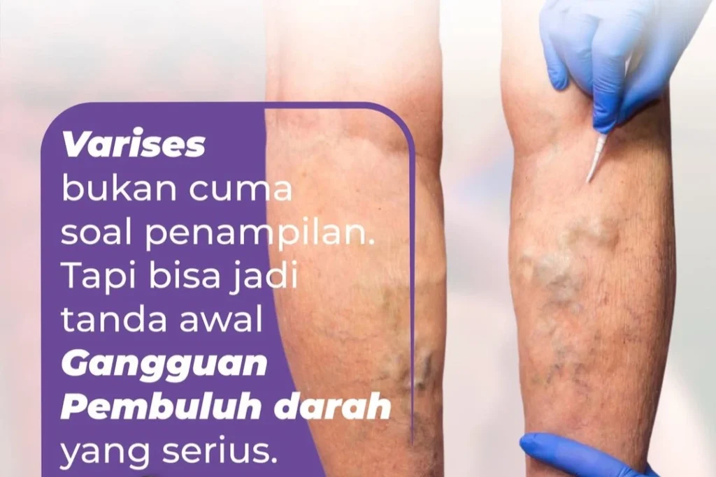varises di kaki akibat pelebaran pembuluh darah vena dan katup vena melemah