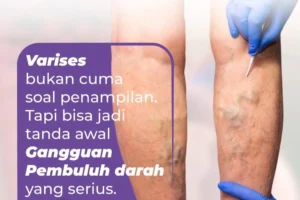 varises di kaki akibat pelebaran pembuluh darah vena dan katup vena melemah