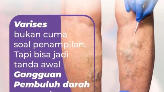 Penyebab dan Pencegahan Varises